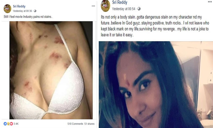 Sri Reddy's curious post with marks on private parts 1 sri reddy marks on body