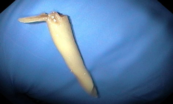 chicken bone rmeoved hyderabad